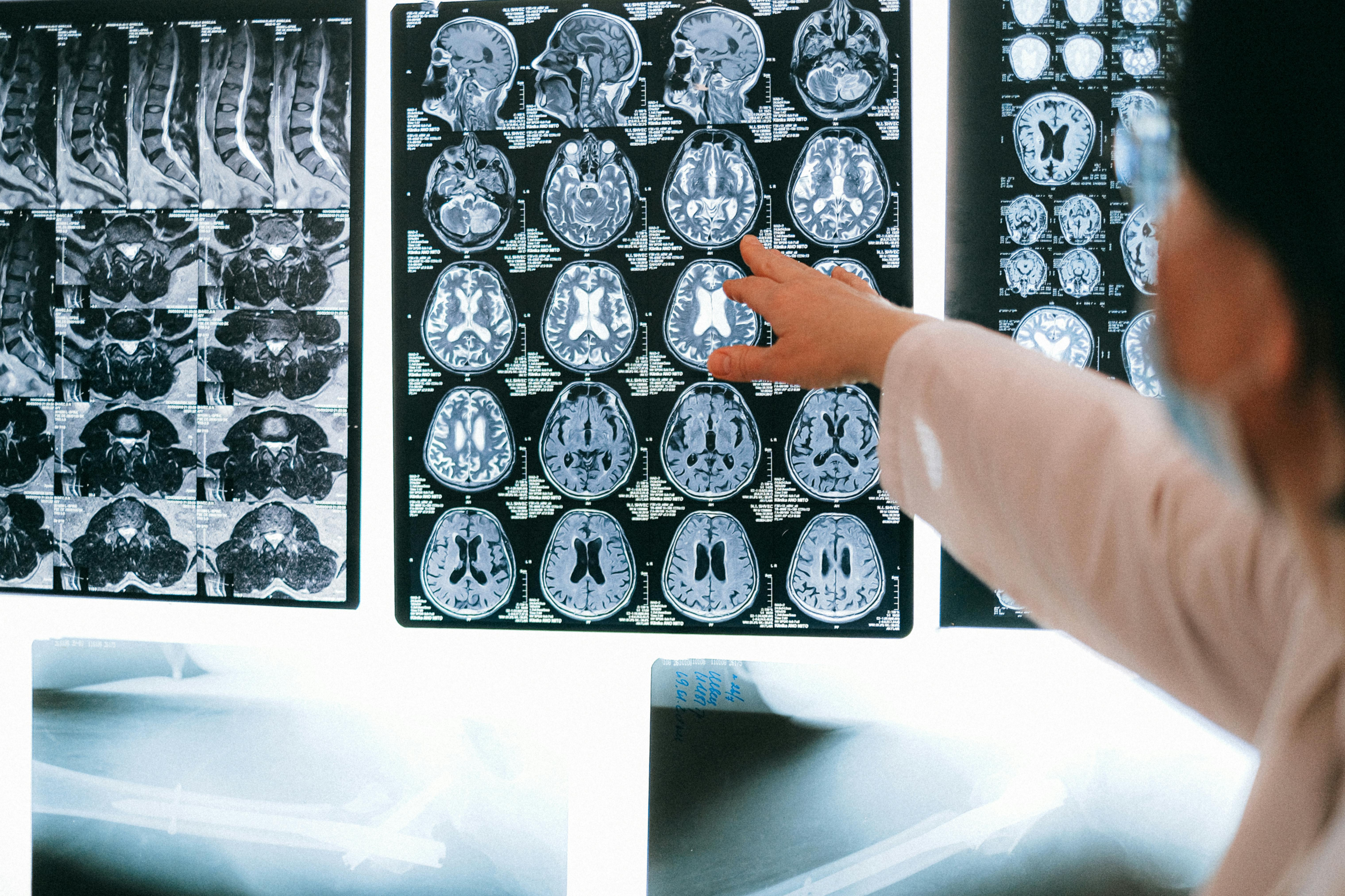 Close-Up of MRI Results - Find Your Spring Hill Traumatic Brain Injury Lawyer at Hancock Injury Attorneys